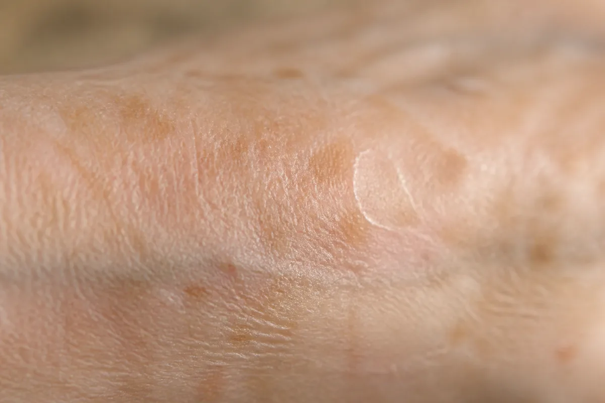 Peau sèche et rugueuse sur un avant-bras de personne âgée en lumière naturelle